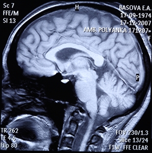 VA performed lobotomies on World War II veterans